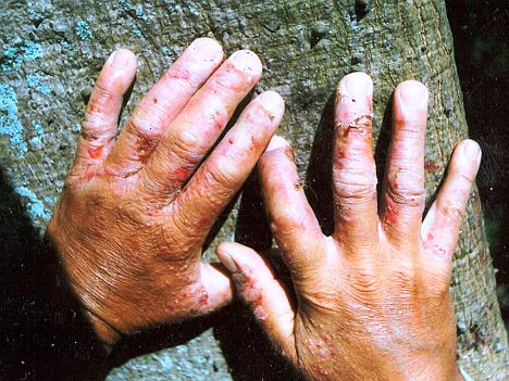 Trópusi betegség kezdete: a bőrön kiütések jelennek meg, a hajlatokban nyálka és repedések. A kéz gazdája azóta már a Fiumei úti sírkertben pihen…